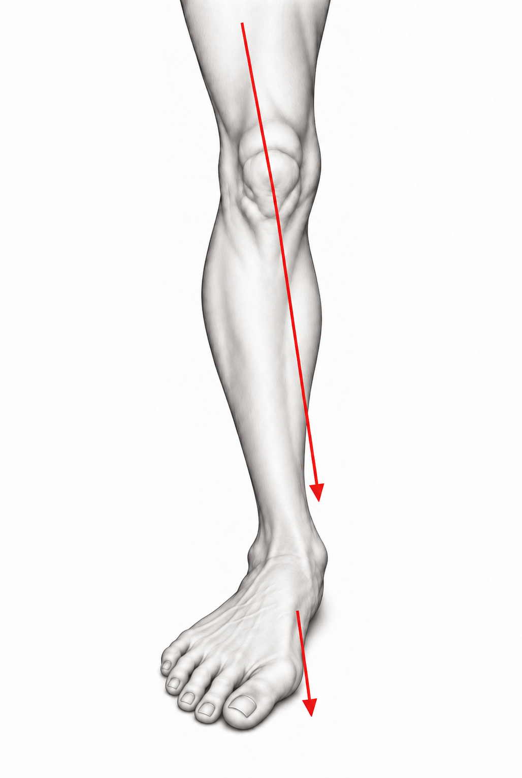 Funktionelle Abweichung mit Oberschenkelinnenrotation,
 nach innen gedrehtem Knie,
 einknickendem Sprunggelenk und Hallux valgus