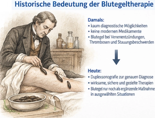 Historische Blutegeltherapie und heutige medizinische Behandlung von Venenerkrankungen
